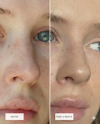 Hydrocolloid Clear-up Strips